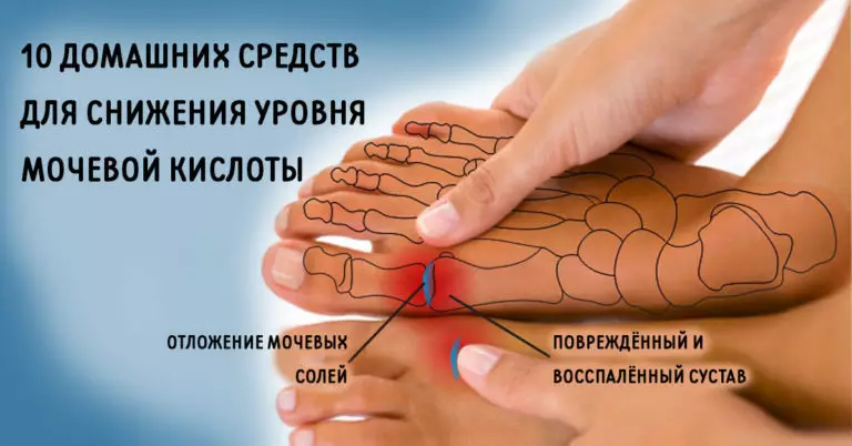 ИЗБАВЬСЯ от мочевой кислоты и вылечи подагру! 10 натуральных средств!