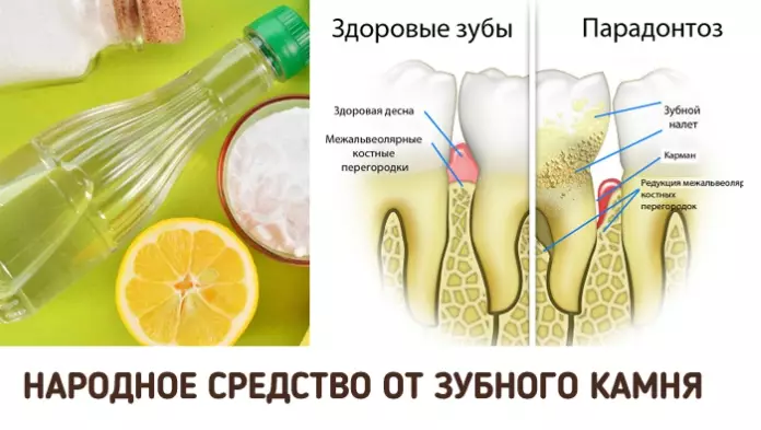 Как удалить зубной камень в домашних условиях? Эффект заметен с первого раза!
