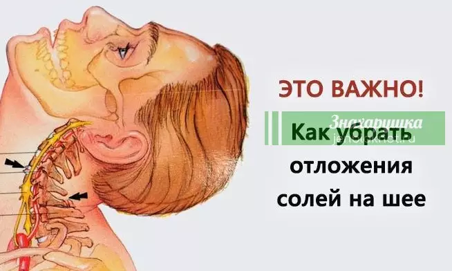 Убираем отложения солей на шее