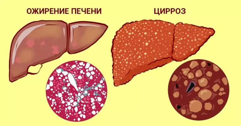 А что, если печень можно вылечить травами. 5 проверенных тысячами людей рецептов