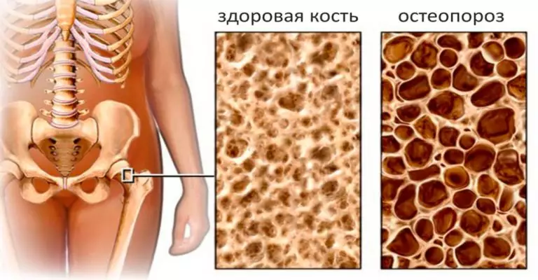 Эти 3 продукта — лучшие защитники костей от остеопороза