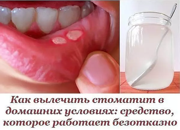 Как в домашних условиях вылечить стоматит: средство, которое работает безотказно