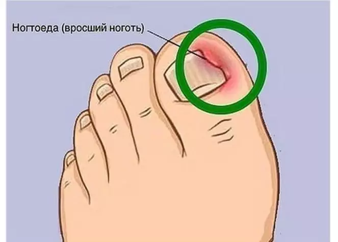 Простым способом решаем проблему вросших ногтей