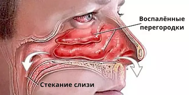 Вот как за пару минут избавиться от насморка