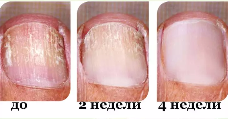 Заметили грибок на ногтях. Действуй немедленно и устрани его быстро