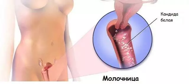 Mногие жeнщины cтрадают от грибковых инфекций, но вылечиться от них возможно и в домашних условиях