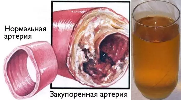Очистите кровеносные сосуды с помощью всего одного стакана этого напитка