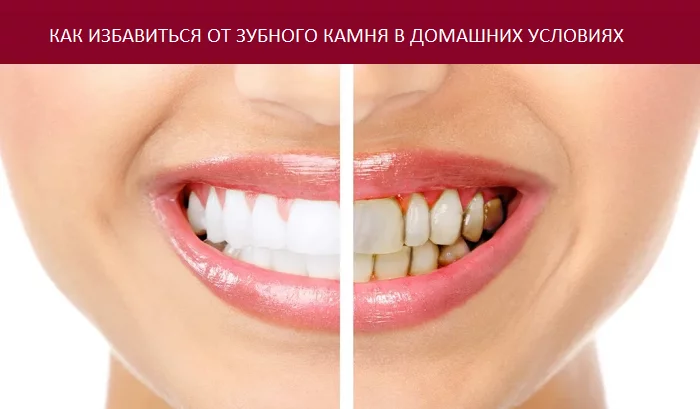 1 классный способ избавиться от зубного камня самому и дома