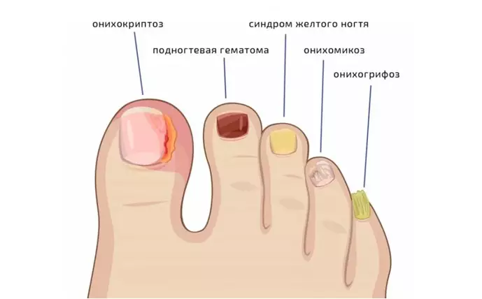Как быстро и просто можно вылечить микоз ногтей