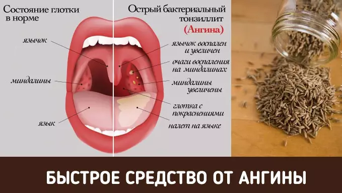 Как избавиться от боли в горле за пару часов
