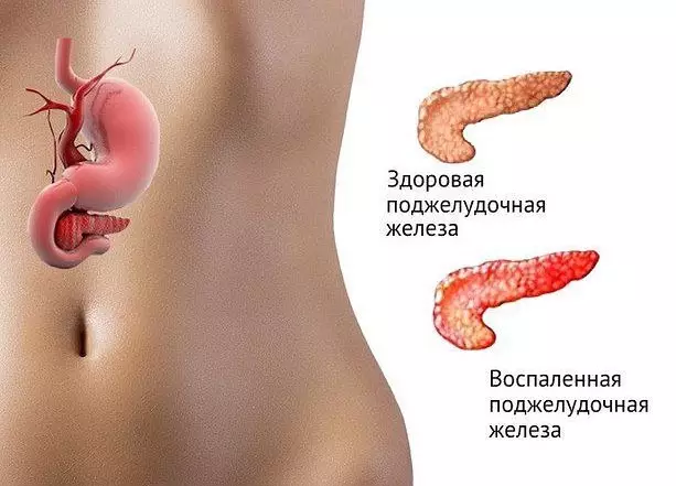 Поджелудочная железа больше не беспокоит…помог единственный продукт