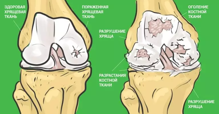 Самый эффективный способ который избавит вас от болей в суставах