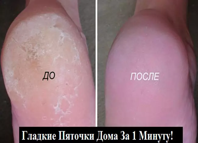 СУПЕР-СРЕДСТВО ДЛЯ ВАШИХ ПЯТОЧЕК. ПОМОГАЕТ ЗА МИНУТУ