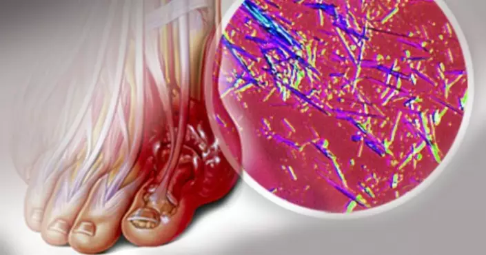 Удали мочевую кислоту и предотврати подагру и боли в суставах. Эти рецепты дают быстрый результат, смотри