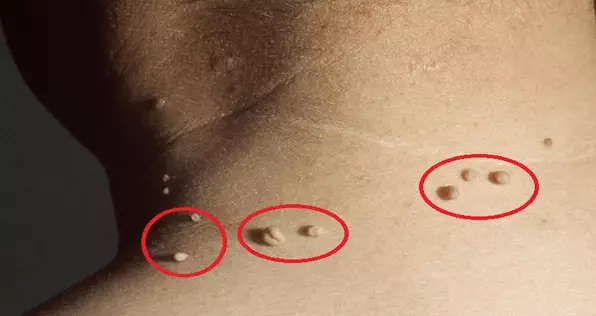 Средство для удаления бородавок и кожных папиллом: легко, безболезненно и дешево