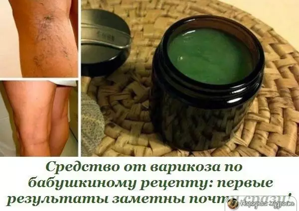 Бабушкин старинный рецепт. Средство от варикоза: первые результаты заметны почти сразу