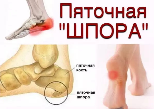 БЫСТРО ВЫЛЕЧИЛА ШПОРУ ЗА 3 ДНЯ