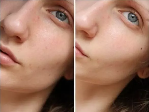 ГЛУБОКАЯ ЧИСТКА ЛИЦА ВСЕГО ЗА 1 ПРОЦЕДУРУ