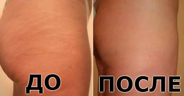 Подруга косметолог посоветовала — масло от растяжек и обвисшей кожи