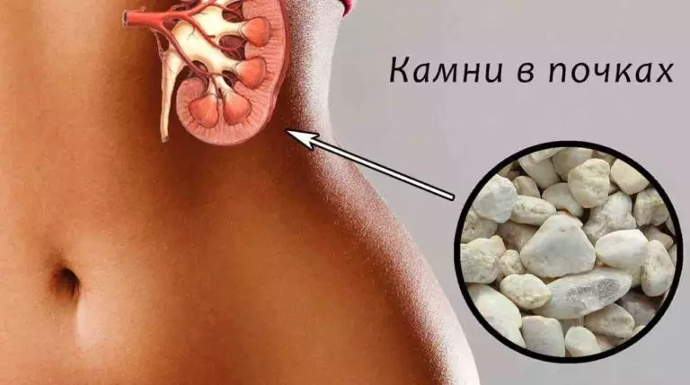 Поделюсь рецептом растворения камней в почках, который неоднократно проверен на родственниках и знакомых