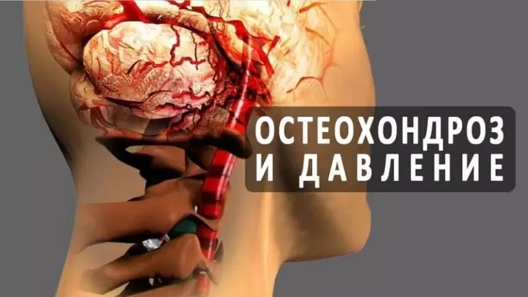 Шейный остеохондроз и скачки давления всегда неразлучная парочка