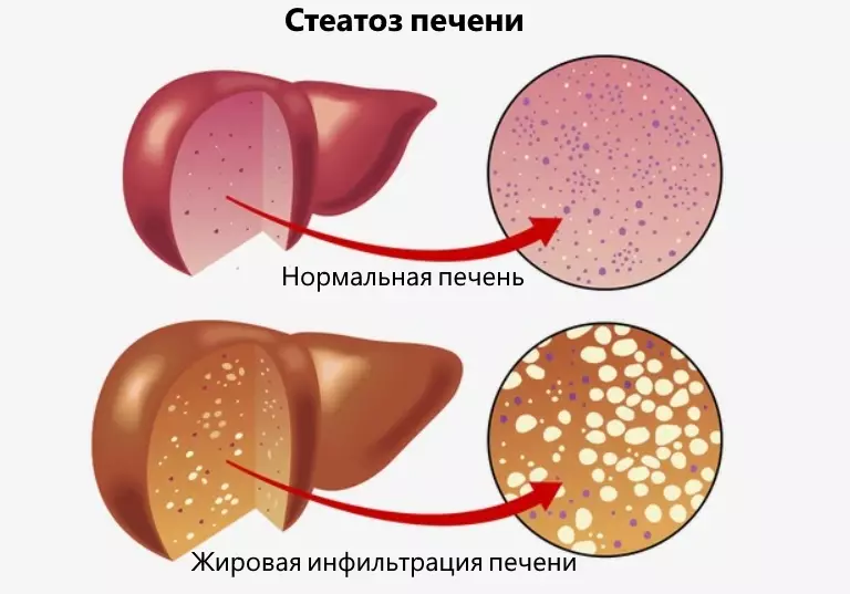 Жировая болезнь печени: 6 предупреждающих сигналов