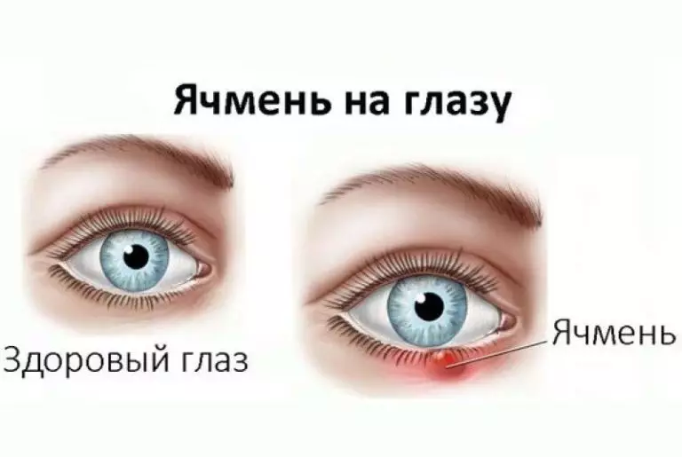 Как Избавиться от ЯЧМЕНЯ На Глазу
