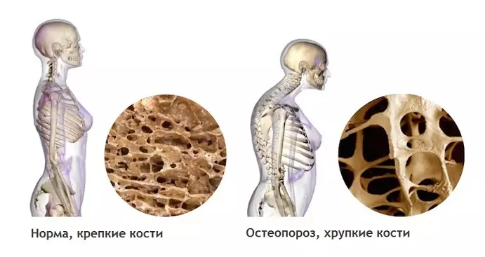 Крепкие кости. Профилактика Остеопороза от Мануального Терапевта