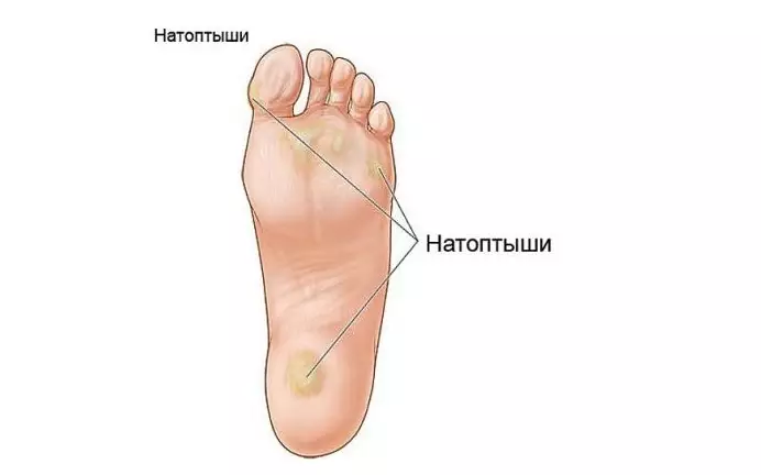 Моментально избавиться от натоптышей и мозолей