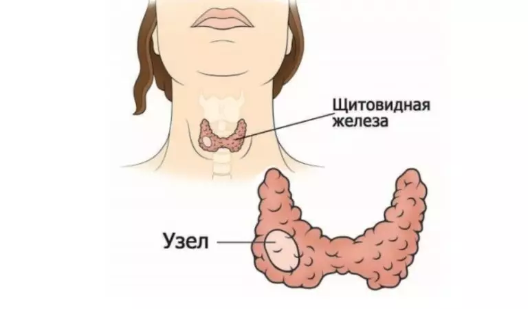 Простой домашний способ избавиться от узла на щитовидной железе