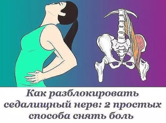 2 простых способа разблокировать седалищный нерв и унять боль