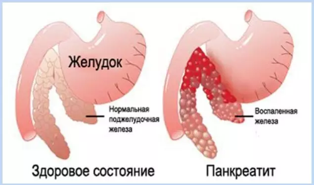 Осторожно: панкреатит. Как вовремя заметить и вылечить