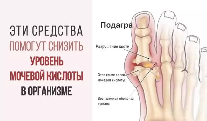 Вот как избавиться от мочевой кислоты и вылечить подагру