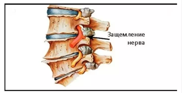 Защемило нерв в спине. 5 минут и боль уйдет