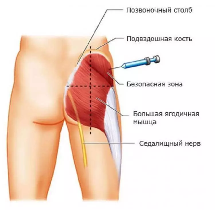 Как правильно делать инъекции. Сохраните себе эту важную информацию