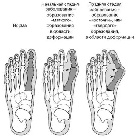 КАК ВЫЛЕЧИТЬ КОСТОЧКУ НА НОГЕ