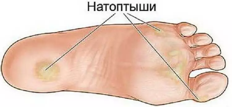 Несколько простых рецептов для устранения натоптышей, трещин, мозолей, сосудистой сетки и варикоза
