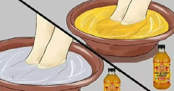 Опустите ноги в яблочный уксус — и болезни уйдут