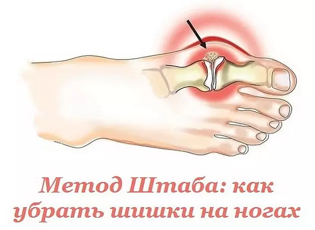 Вот это да. Эффективный метод Н.Н. Штаба избавит от болезненной шишки на ноге