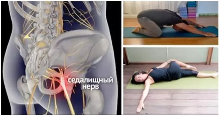 8 простых упражнений, которые помогут избавиться от защемления седалищного нерва