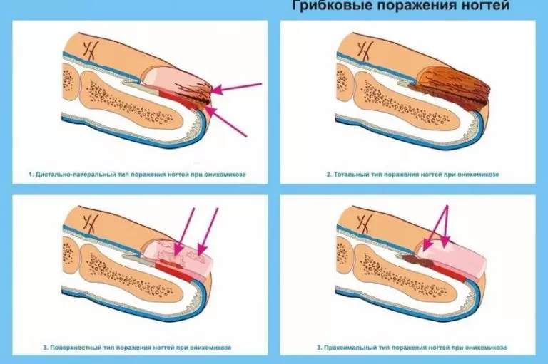 Как вылечить грибок на ногтях