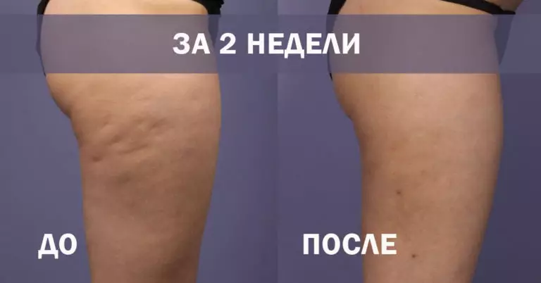 Целлюлит исчезнет волшебным образом. Древнее проверенное средство+супер эффективные упражнения