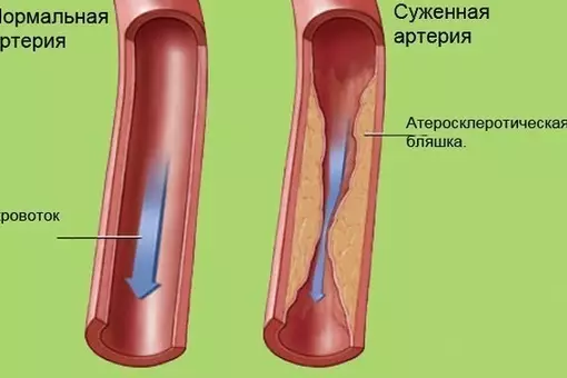 Очищение сосудов. Лучшие методики