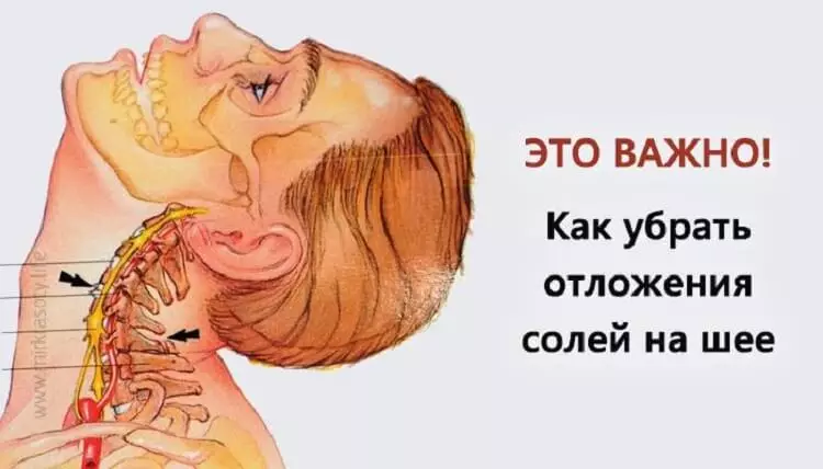 Убираем в шейном отделе позвоночника отложения солей