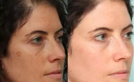 Unlocking Ageless Beauty: Homemade Masks for Wrinkles and Age Spots