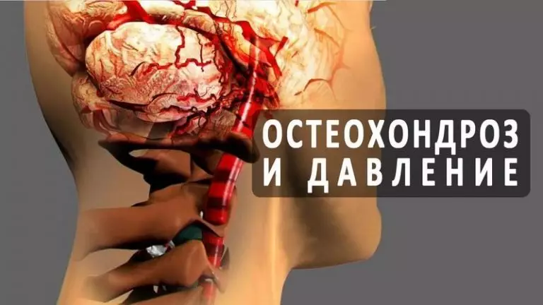 Шейный остеохондроз и высокое давление как неразлучная парочка