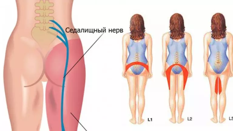 2 простых способа разблокировать седалищный нерв и унять боль