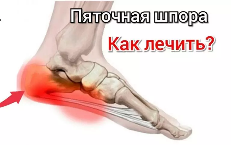 БЫСТРО ВЫЛЕЧИЛА ШПОРУ ЗА 3 ДНЯ