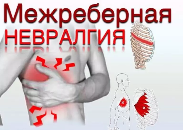 ЛЕЧИМ МЕЖРЕБЕРНУЮ НЕВРАЛГИЮ