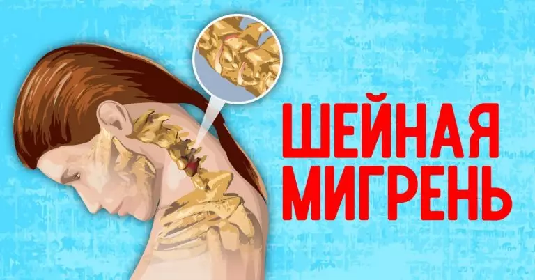 ШЕЙНАЯ МИГРЕНЬ: не старайтесь побороть таблетками